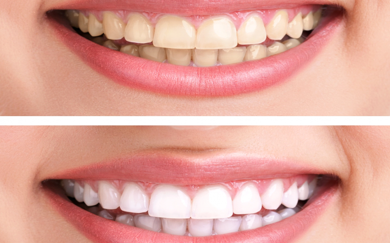 Dos Don ts For After You Get Your Teeth Whitened The Blogging Doctors
