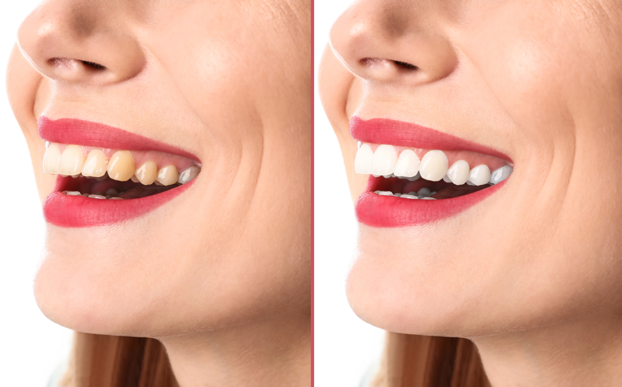 Say Cheese! 5 Simple Steps to a Brighter, Whiter Smile in 2024