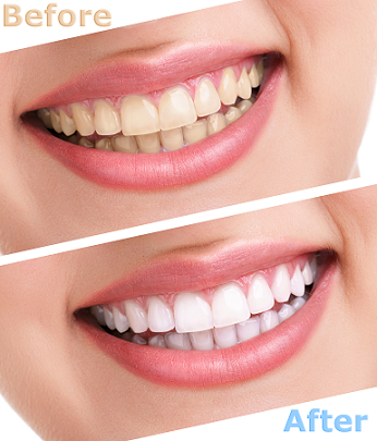 5 Tips for Whiter Teeth