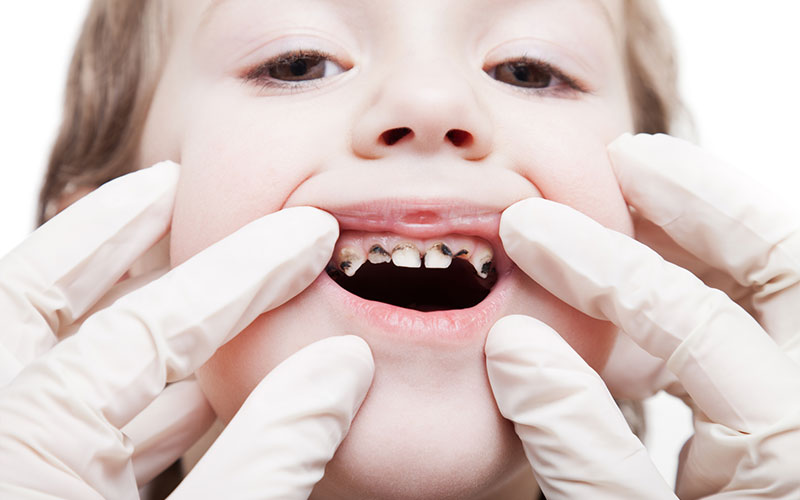 Tooth Decay in Children – A Common Dental Problem