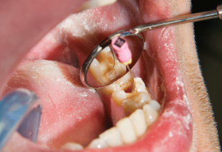 9 Preventive Tips on How to Avoid Root Canal Naturally
